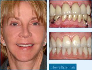 dental implants surgery, dental loans